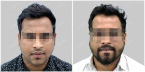 Men hair transplant before and after