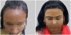 female hair transplant in india before and after