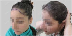 female hair transplant | Satya hair solutions