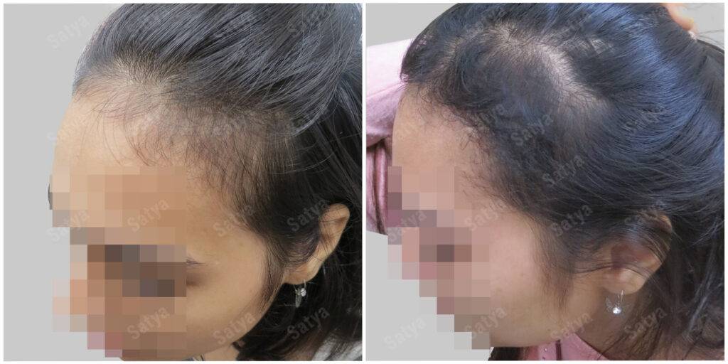 female hair transplant | Satya hair solutions