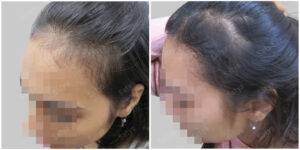 female hair transplant | Satya hair solutions