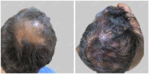 fue hair transplant
