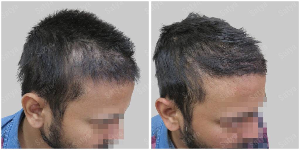 repair hair transplant