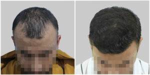 before and after hair transplant results