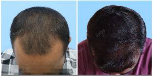 hair transplant before after results