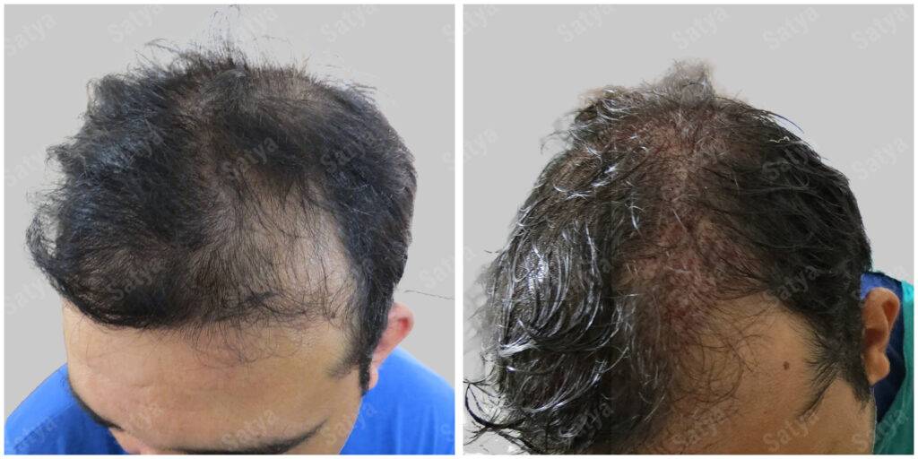fue hair transplant