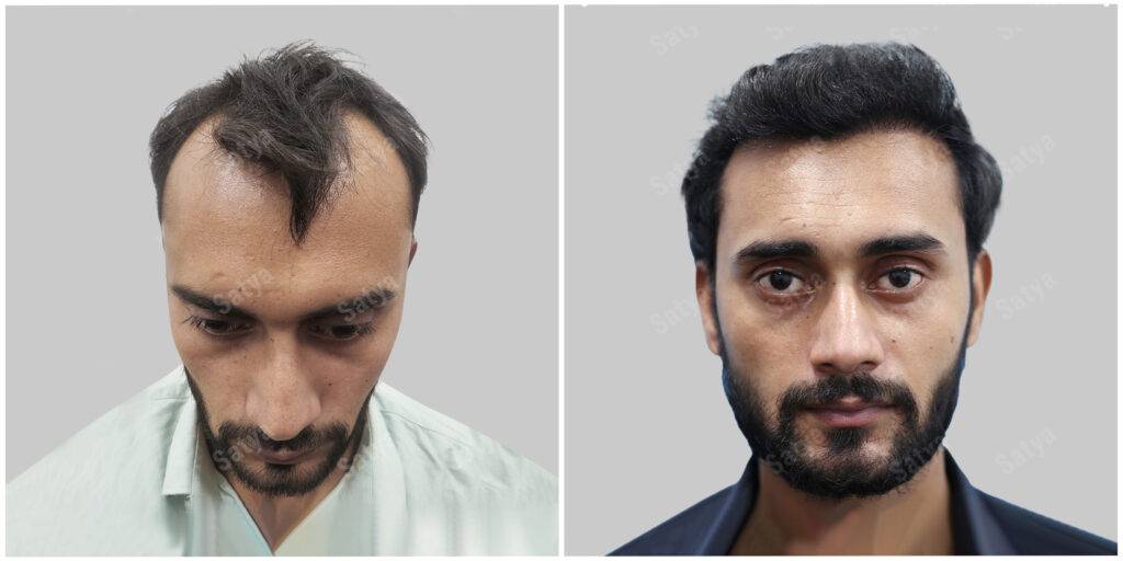hair transplant before and after