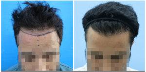 hair transplant before after results