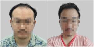 hair transplant before and after