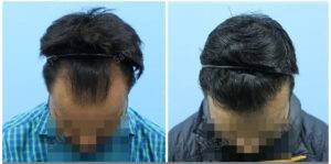 hair transplant before after results