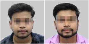 mustache hair transplant