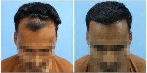 hair transplant before after results