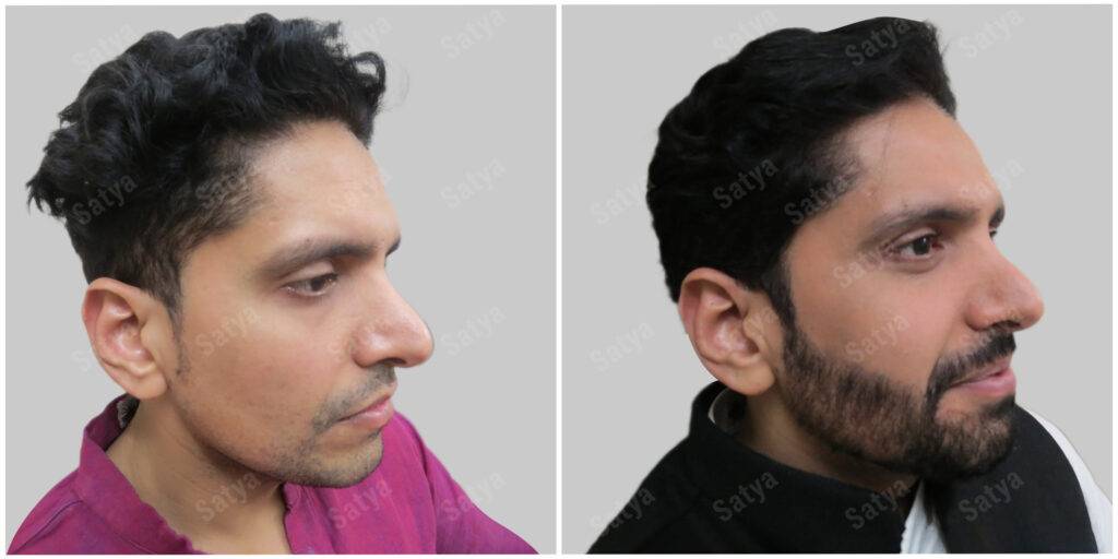 Arun hair transplant before and after results