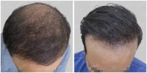 Hair Transplant for Men | Satya hair Solution