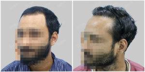 hair transplant before and after