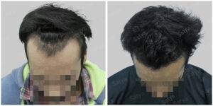 hair transplant before after results