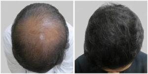 fue hair transplant