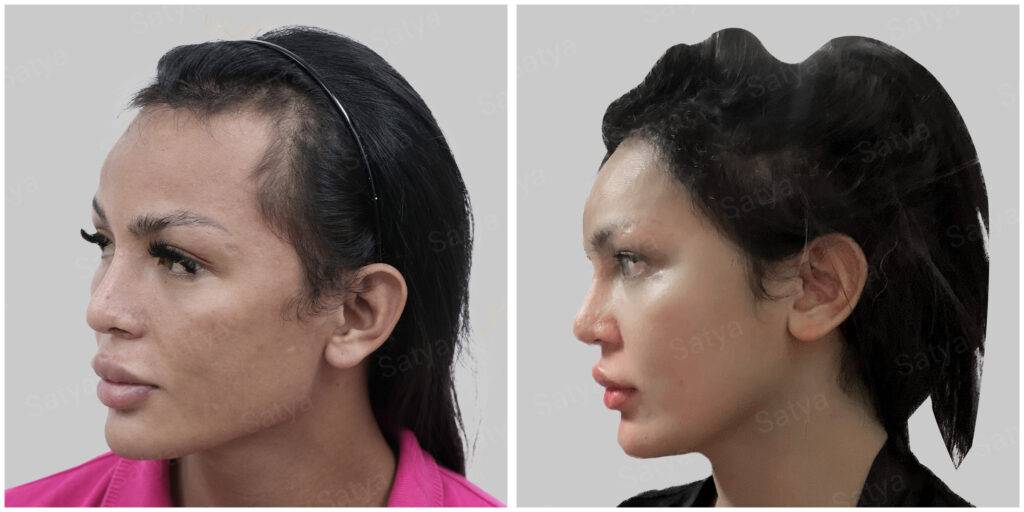 fue hair transplant