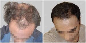 hair transplant