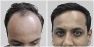 repair hair transplant