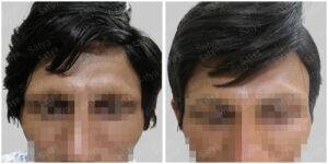 before and after hair transplant results