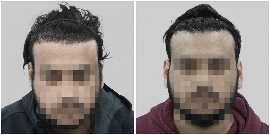 hair transplant