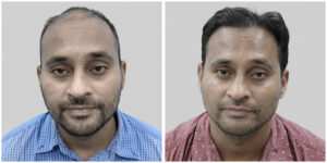 repair hair transplant