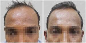 before and after hair transplant results