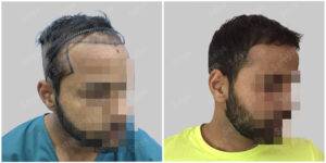 hair transplant results at satya hair solutions