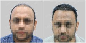 hair transplant before and after