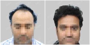 hair transplant before and after