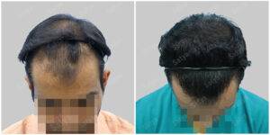 hair transplant results at satya hair solutions