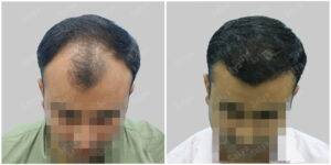 hair transplant before and after