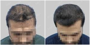 hair transplant before and after