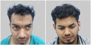 hair transplant before and after