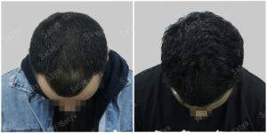 hair transplant before and after