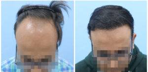 hair transplant before after results