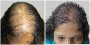 female hair transplant - Satya hair solutions