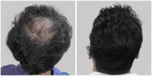 fue hair transplant