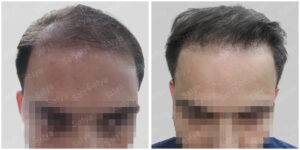 men hair transplant - Satya hair solutions