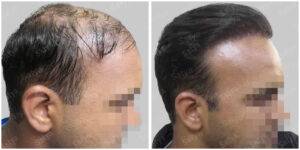 before and after hair transplant results