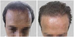 before and after hair transplant results