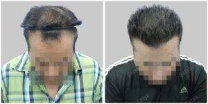 before and after hair transplant results
