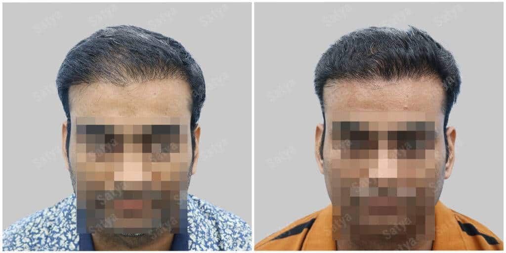 hair transplant results at satya hair solutions