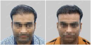 hair transplant results at satya hair solutions