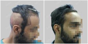 hair transplant results at satya hair solutions