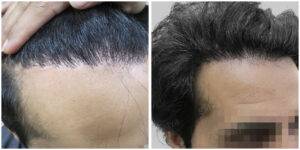 repair hair transplant