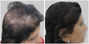 female hair loss before and after