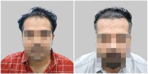 hair transplant results at satya hair solutions