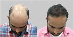 hair transplant results at satya hair solutions